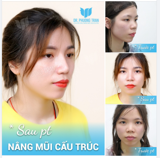 NÂNG MŨI XONG GIẢM BỚT HÔ HÀM LÀ ĐÂY