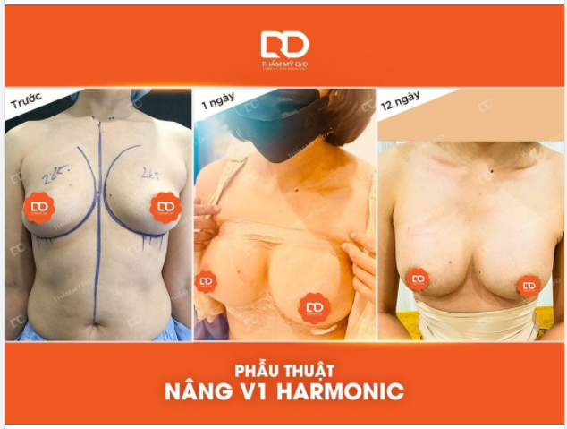 Nâng ngực phải nằm viện trong bao lâu?