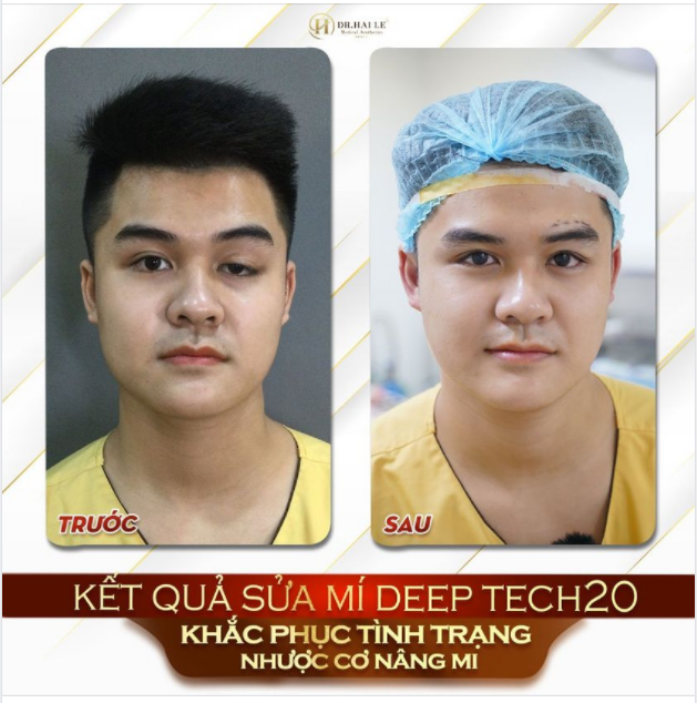 Nếu bạn là nam giới còn đang băn khoăn: NÊN HAY KHÔNG THẨM MỸ MẮT thì xem ngay hình ảnh dưới đây nhé!
