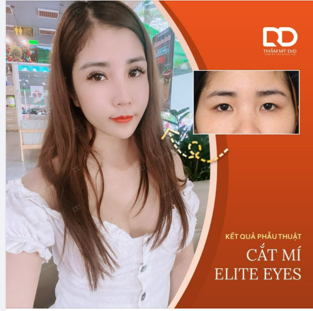 Nhấn mí tự nhiên thật đấy nhưng hiệu quả chỉ được vài năm. Nhưng Cắt mí lại sợ trông già.