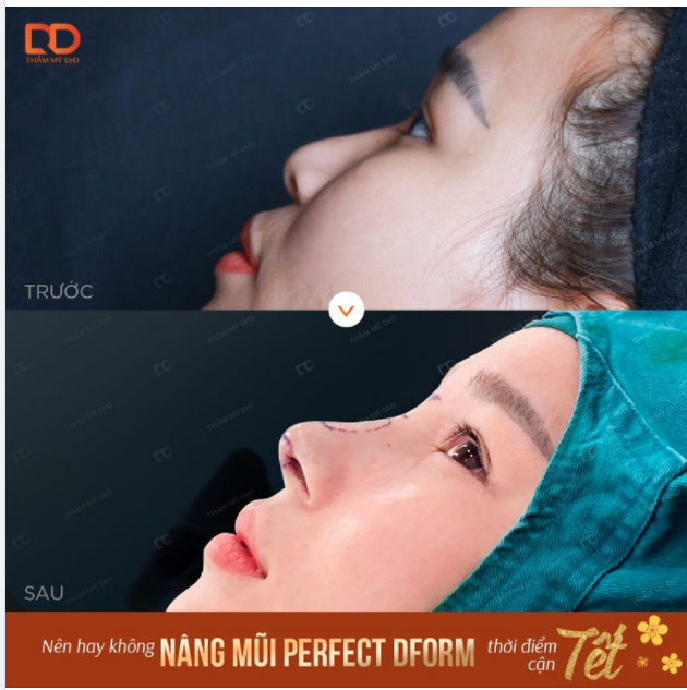 Những ngày cận kề Tết thế này, có nên thực hiện Nâng mũi hay không