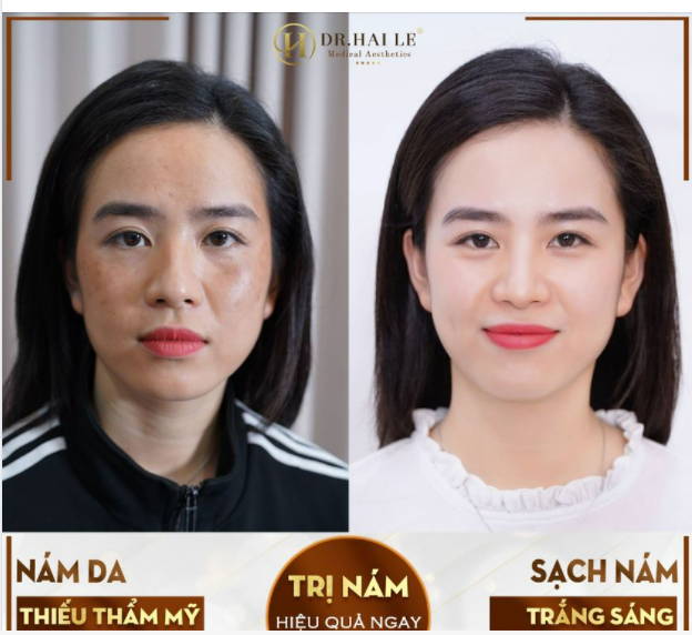 NỖI ÁM ẢNH "MẤT TIỀN, MẤT SẮC". LÀM SAO ĐỂ ĐIỀU TRỊ NÁM DA ĐÚNG CÁCH...