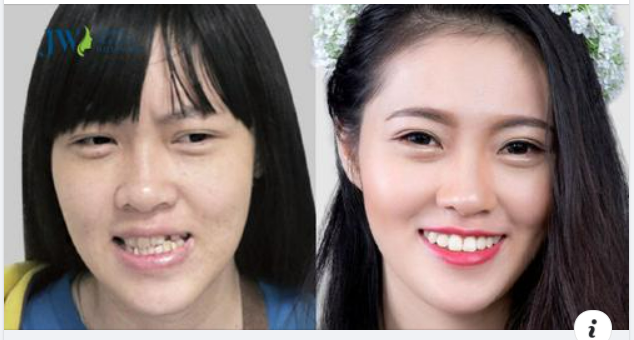 PHẪU THUẬT CHỮA MẶT LỆCH Ở ĐÂU AN TOÀN VÀ KHÔNG ĐAU