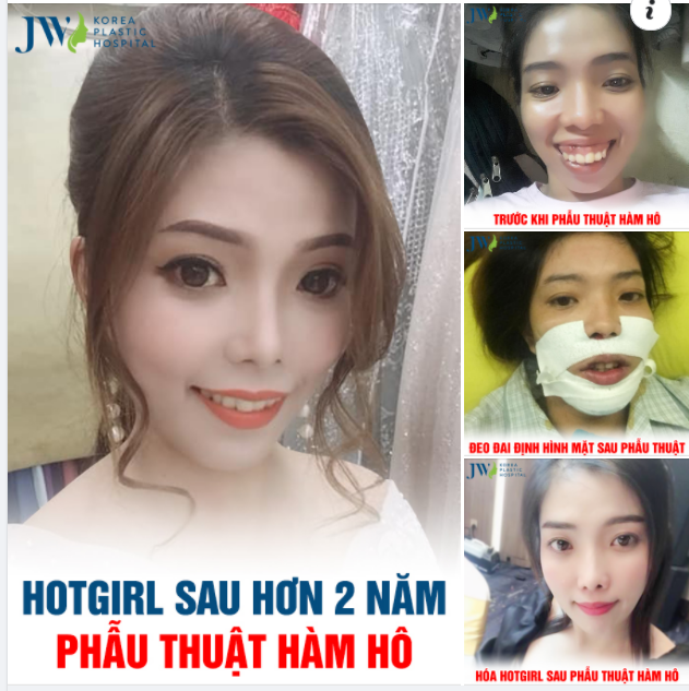 PHẪU THUẬT HÀM HÔ THỊ NỞ HÓA NÀNG THƠ