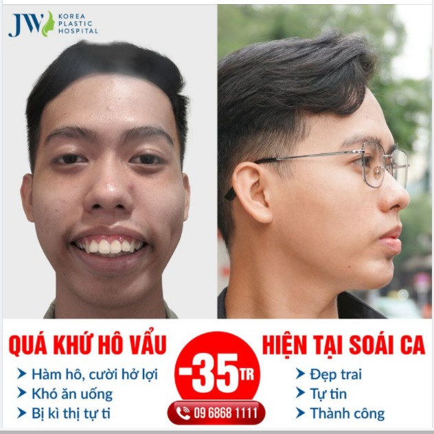 PHẪU THUẬT HÀM HÔ TỪ HÔ VẨU THÀNH SOÁI CA HÀN QUỐC