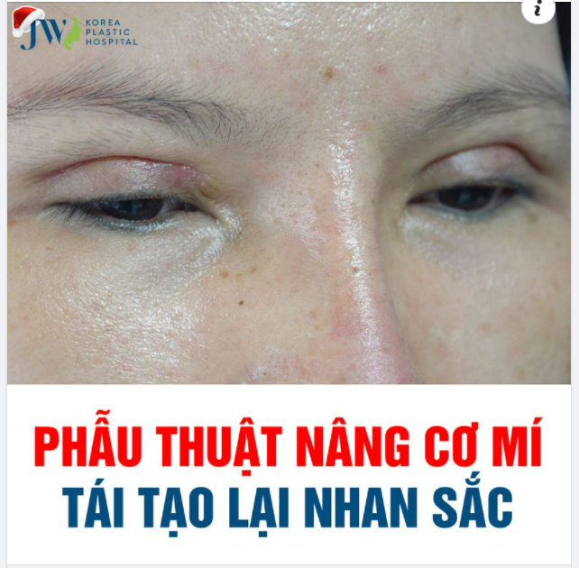 PHẪU THUẬT NÂNG CƠ MÍ MẮT DÀNH CHO NHỮNG AI?