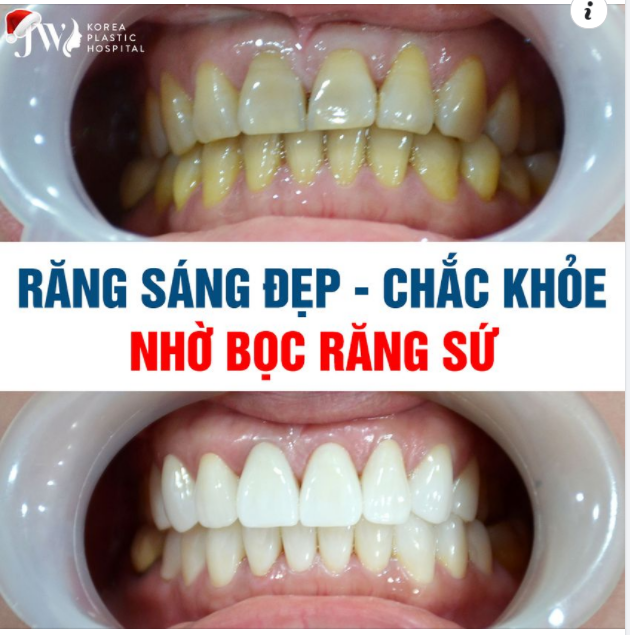 RĂNG CHẮC KHỎE TRẮNG SÁNG TỰ NHIÊN SAU KHI BỌC RĂNG SỨ