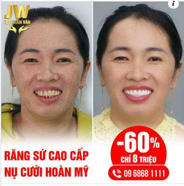 RĂNG SỨ TRẮNG SÁNG - TỰ TIN KHOE NỤ CƯỜI TỎA NẮNG