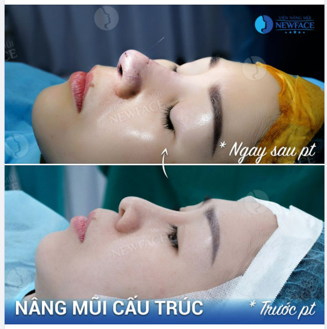 RẤT NHIỀU BẠN NÂNG MŨI XONG BỊ NHƯ THẾ NÀY!