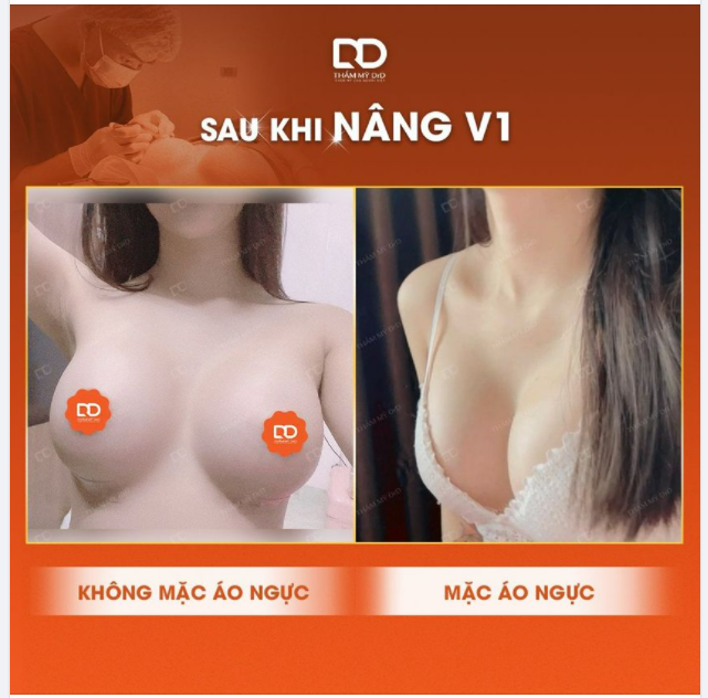 Sự khác biệt giữa việc chưa làm ngực và sau khi làm ngực.