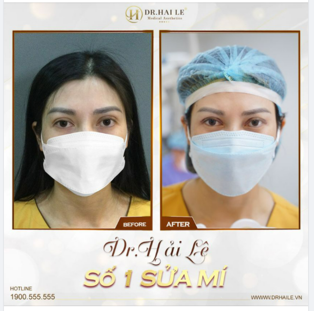 SỬA LẠI MÍ ĐÃ CẮT BỊ LỖI, HỎNG VÀ NHỮNG LƯU Ý TUYỆT ĐỐI BẠN KHÔNG NÊN BỎ QUA!