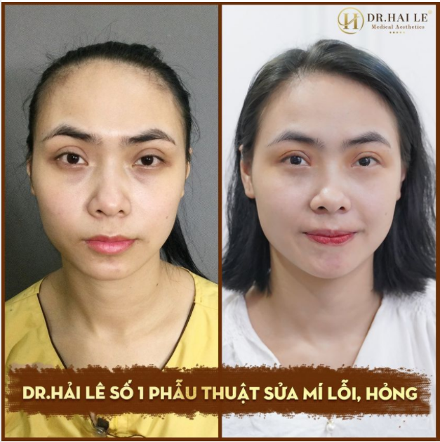 SỬA MÍ DEEP TECH20 - BẠN TRAO NIỀM TIN, DR.HẢI LÊ TRAO BẠN SỰ TỰ TIN.!!