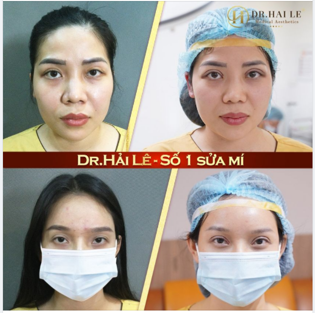 "Sửa mí xong nhẹ hẳn người' "Nếu không sửa mí ở Dr.Hải Lê, thì không biết sửa ở đâu"