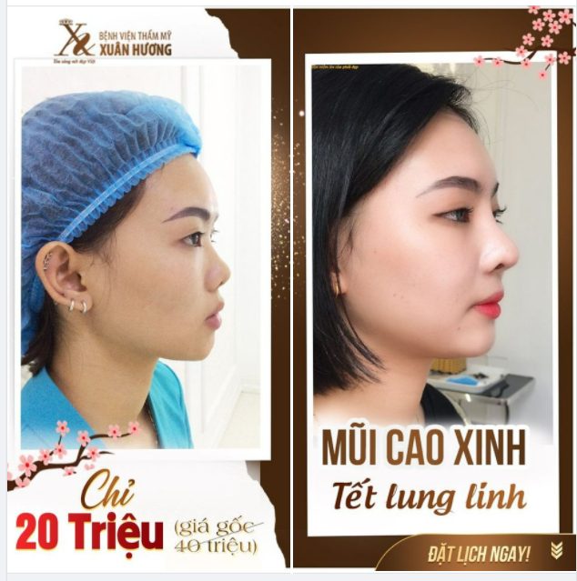THAY ĐỔI DÁNG MŨI - SÁNG BỪNG KHUÔN MẶT LÀ CÓ THẬT!