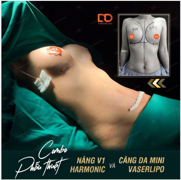 Thực hiện Combo Nâng V1 và Căng da bụng sau bao lâu thì đi làm lại được
