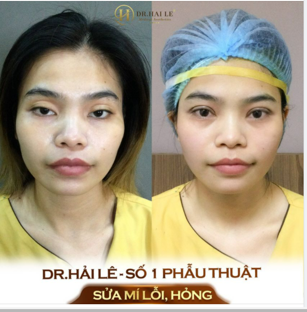 TIỀN MẤT TẬT MANG khi cắt mí tại cơ sở kém chất lượng.!