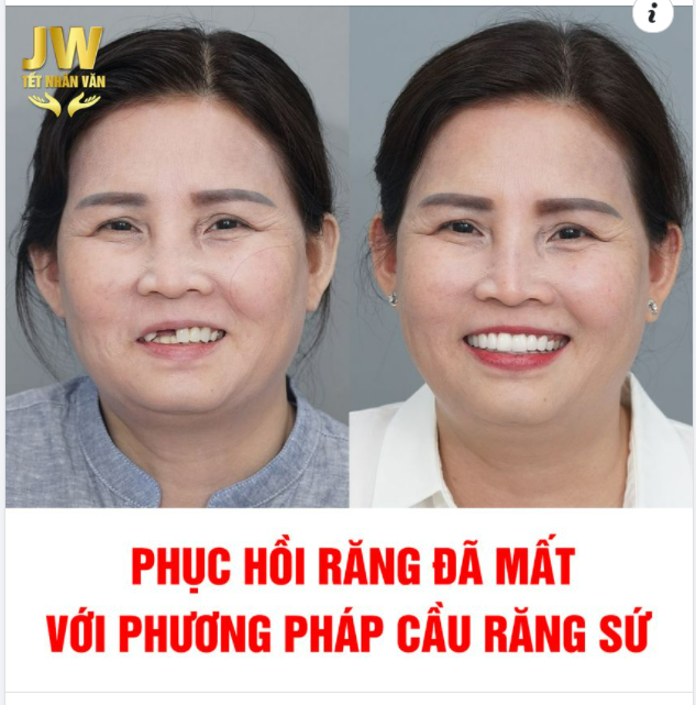 TIN ĐƯỢC KHÔNG: U60 TRẺ RA CHỤC TUỔI SAU KHI PHỤC HỒI RĂNG ĐÃ MẤT