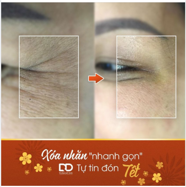 Trẻ hóa bằng tinh chất thư giãn cơ cho những ai cần xóa nhăn cấp tốc những ngày cận Tết.