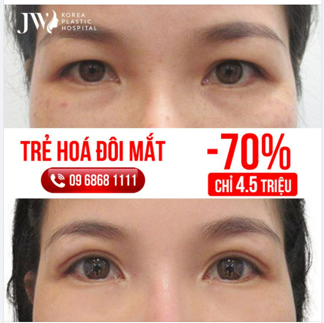 TRẺ HOÁ TOÀN DIỆN ĐÔI MẮT - TRẺ RA 20 TUỔI TRONG CHỚP MẮT