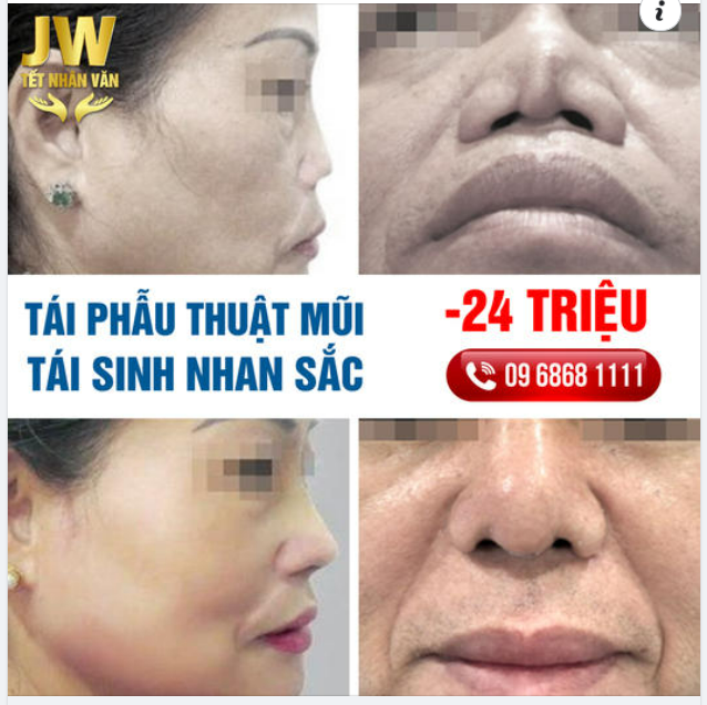 TRỢ GIÁ TÁI PHẪU THUẬT, TÁI SINH CHIẾC MŨI S LINE CHUẨN Á ĐÔNG