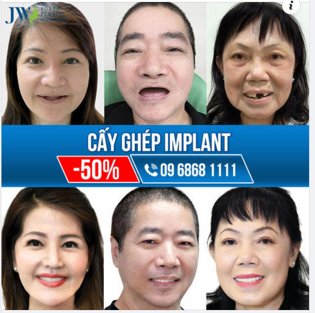 TRỒNG RĂNG IMPLANT HẾT SỢ MẤT RĂNG VĨNH VIỄN VUI VẺ ĐÓN TẾT ĐOÀN VIÊN