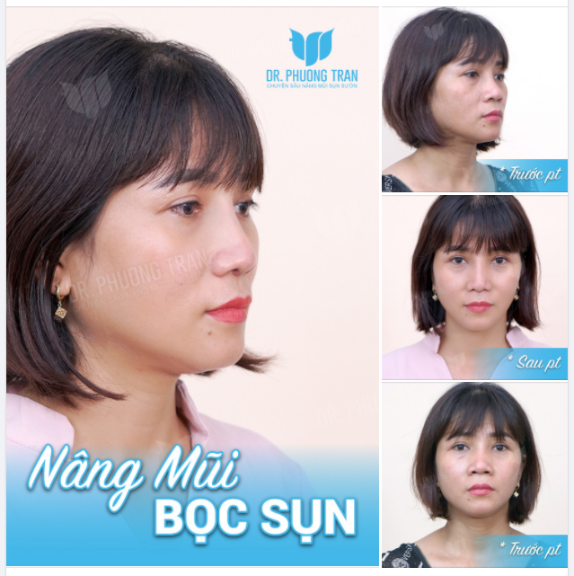 U LÀ TRỜI…THAY ĐỔI NGOẠN MỤC NHỜ NÂNG MŨI BỌC SỤN