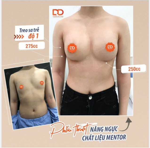 Với những khuôn ngực nguyên bản, việc hai bên ngực có kích thước không cân xứng, hình dáng khác nhau là điều bình thường.