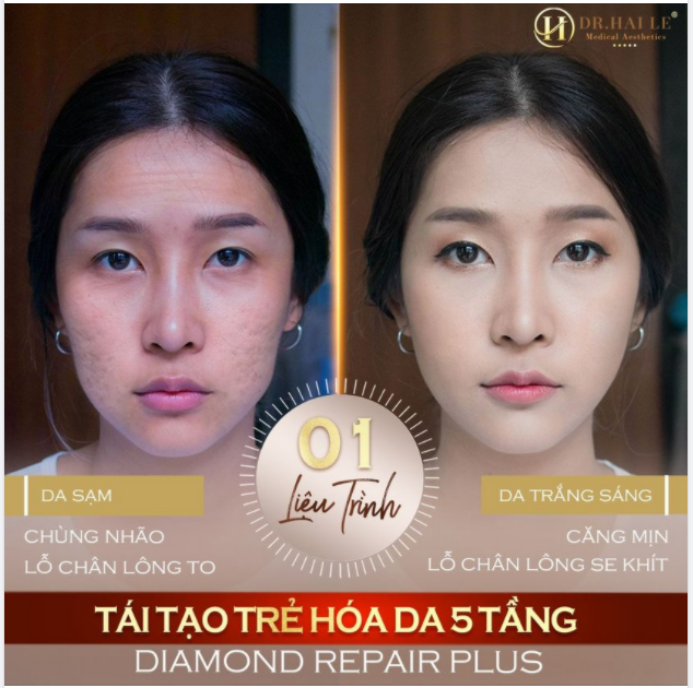XINH ĐẸP VÀ HẠNH PHÚC.!  Với công nghệ Tái tạo trẻ hóa da 5 tầng Diamond Repair Plus nhà Dr.Hải Lê.!