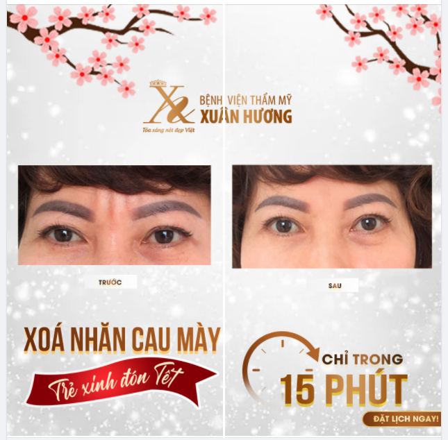 XÓA VẾT CAU MÀY "KHÓ TÍNH" CHỈ SAU 15 PHÚT THỰC HIỆN