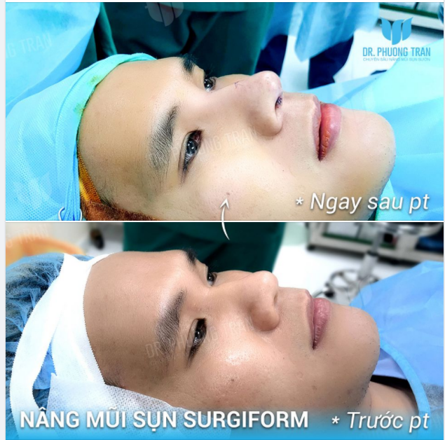 XỬ LÝ MŨI GỒ CHO NAM GIỚI AI NGHĨ ĐƠN GIẢN THẾ NÀY