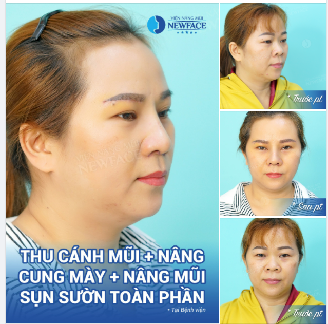 Ca combo Nâng mũi sụn sườn Kèm Thu Cánh Mũi Và Nâng Cung Mày