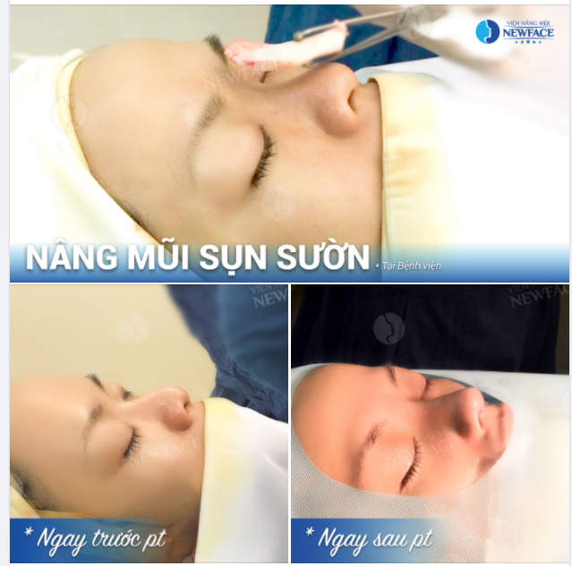 CA MŨI SỤN SƯỜN ĐẦU NGÀY