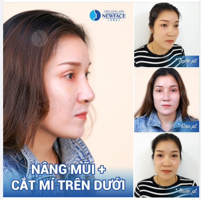 CA NÂNG MŨI + C..Ắ..T MÍ TRÊN DƯỚI 14 NGÀY - QUÁ KHÁC BIỆT