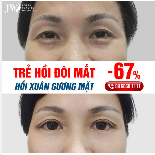 CẮT MẮT HAI MÍ - NÂNG CẤP CỬA SỔ T M HỒN, THĂNG CẤP SỰ SỰ TIN