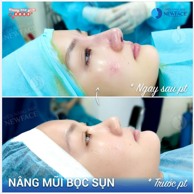 CHÈN ƠI, “CỰC PHẨM” NÂNG MŨI ĐẶT SỐNG