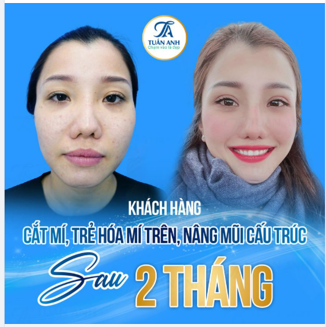 Chị N. đã từng 2 lần PTTM mũi nhưng vẫn bị hỏng, sống mũi vẹo, lệch, mất cân đối và mất thẩm mỹ.