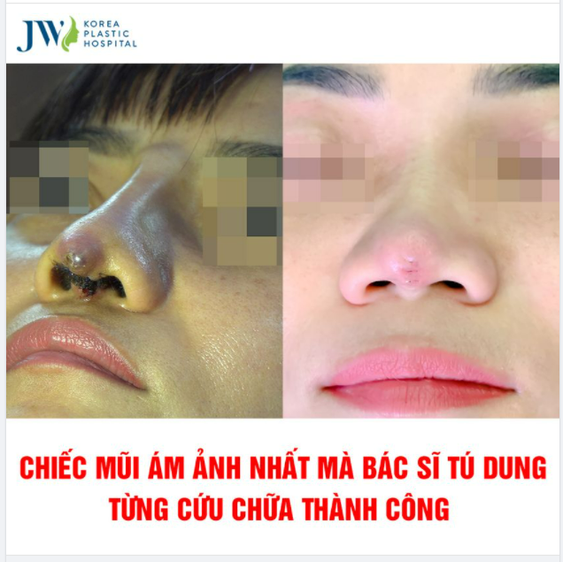 CHIẾC MŨI ÁM ẢNH NHẤT MÀ BÁC SĨ TÚ DUNG TỪNG CỨU CHỮA THÀNH CÔNG