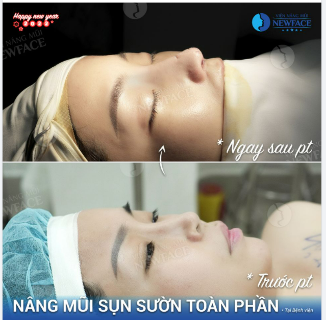 CHIẾC MŨI HÓP BIẾN HÓA HOÀN HẢO NHỜ NÂNG SỤN SƯỜN