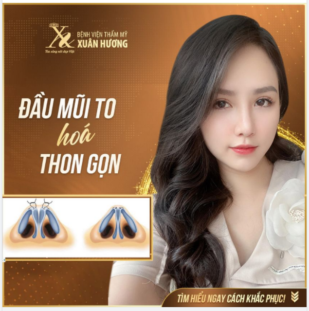 ĐẦU MŨI TO BÈ, THÔ XỬ LÝ NHƯ THẾ NÀO TRONG PHẪU THUẬT THẨM MỸ