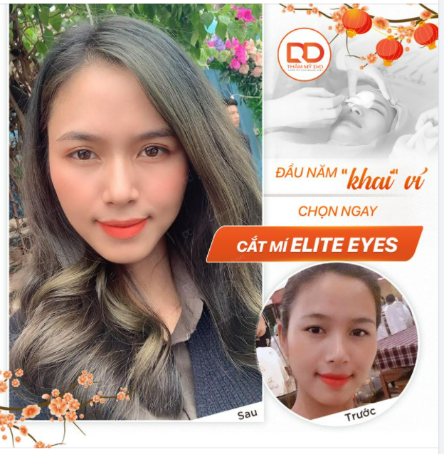 Đầu năm khai ví chốt ngay deal Cắt mí Elite Eyes nhè nhẹ để cả năm luôn xinh tươi nhé các nàng.