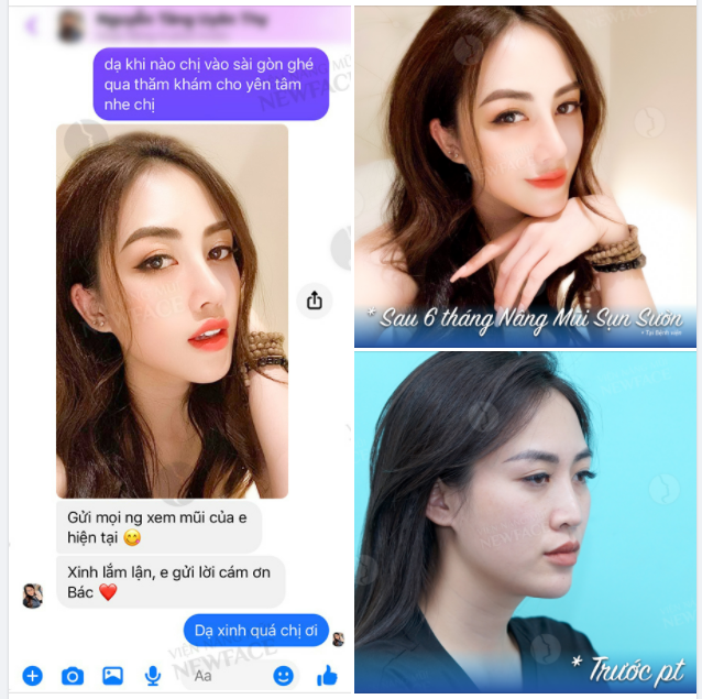 FEEDBACK “CHẤT LƯỢNG” SAU 6 THÁNG SAU NÂNG MŨI SỤN SƯỜN