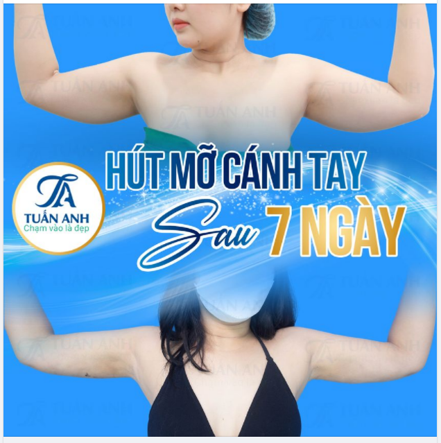 Feedback sau 7 ngày hút mỡ cánh tay giảm ngay 8cm đây ạ