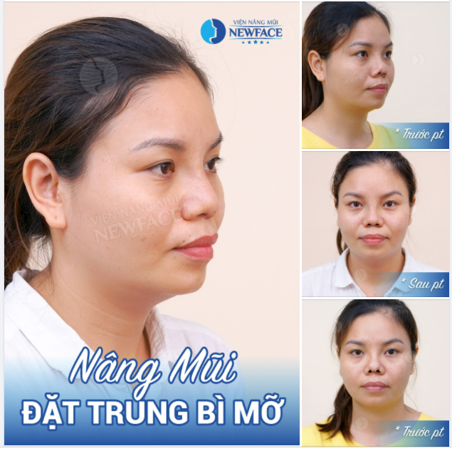 “GIẢI CỨU” CHIẾC MŨI CO RÚT GÂY SẸO