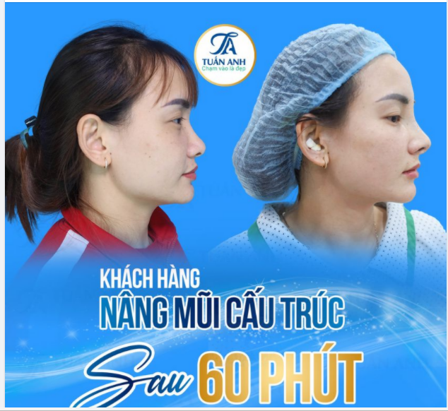 Kết quả ngay sau khi Khách hàng trải nghiệm dịch vụ Nâng mũi Cấu trúc tai Thẩm mỹ Tuấn Anh