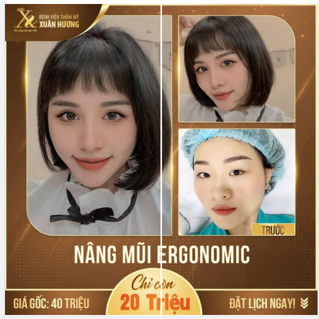 KHUYẾT ĐIỂM Ở ĐÂU KHẮC PHỤC Ở ĐÓ, MŨI THẤP TẸT THÌ ĐÃ CÓ NÂNG MŨI ERGONOMIC TẠI XUÂN HƯƠNG