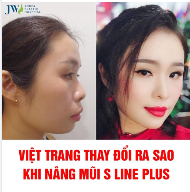 LẦN ĐẦU CÔNG KHAI SỬA MŨI ĐÃ THAY ĐỔI BƯỚC NGOẶC CỦA DIỄN VIÊN HÀI VIỆT TRANG NHƯ THẾ NÀO