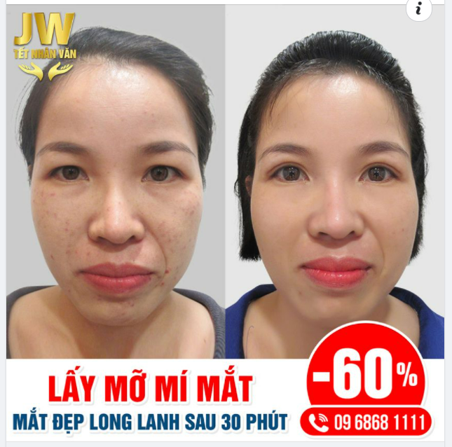 LẤY MỠ MÍ MẮT ĐÔI MẮT ĐẸP LONG LANH CHỈ SAU 30 PHÚT