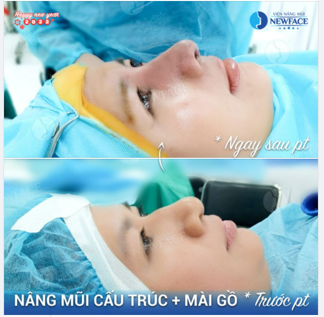 MỘT CA MŨI KHÓ CÓ CAN THIỆP MÀI GỒ