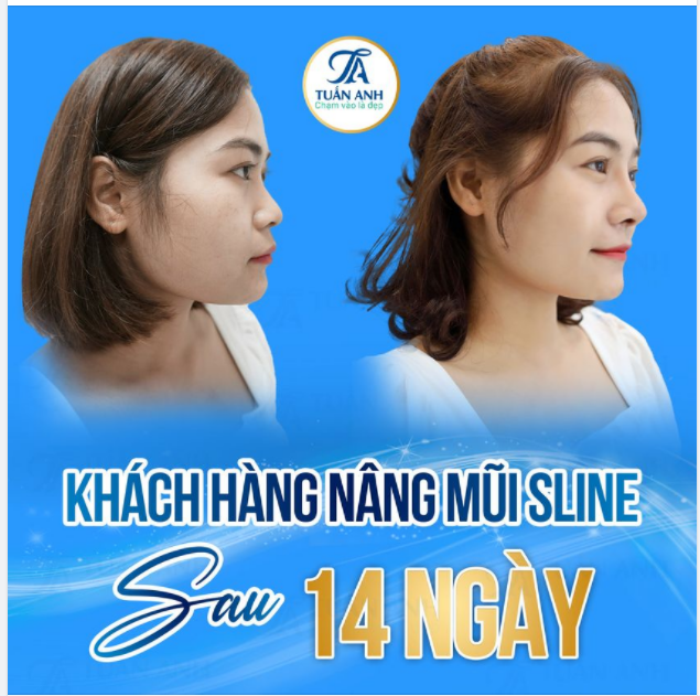 Mũi thấp khiến bạn gái kém xinh, mất cả tự tin trong giao tiếp