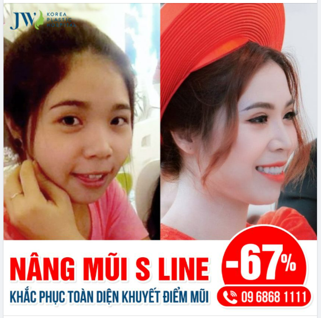 NÂNG MŨI S LINE - ĐỊNH NGHĨA MỚI CỦA VẺ ĐẸP HOÀN MỸ